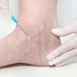 Carmella espinoza underwent for the treatment of spider veins