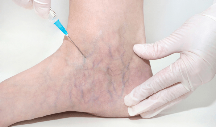 Carmella espinoza underwent for the treatment of spider veins