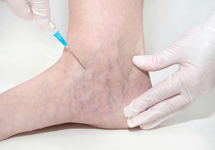 Carmella espinoza underwent for the treatment of spider veins